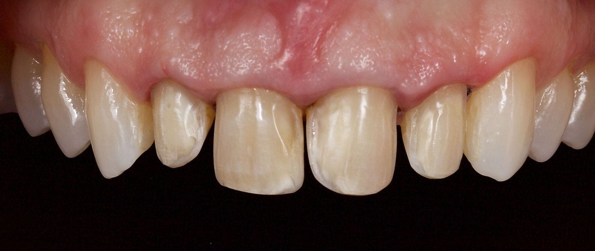 Replacement of porcelain laminate veneers The Restorative Programme