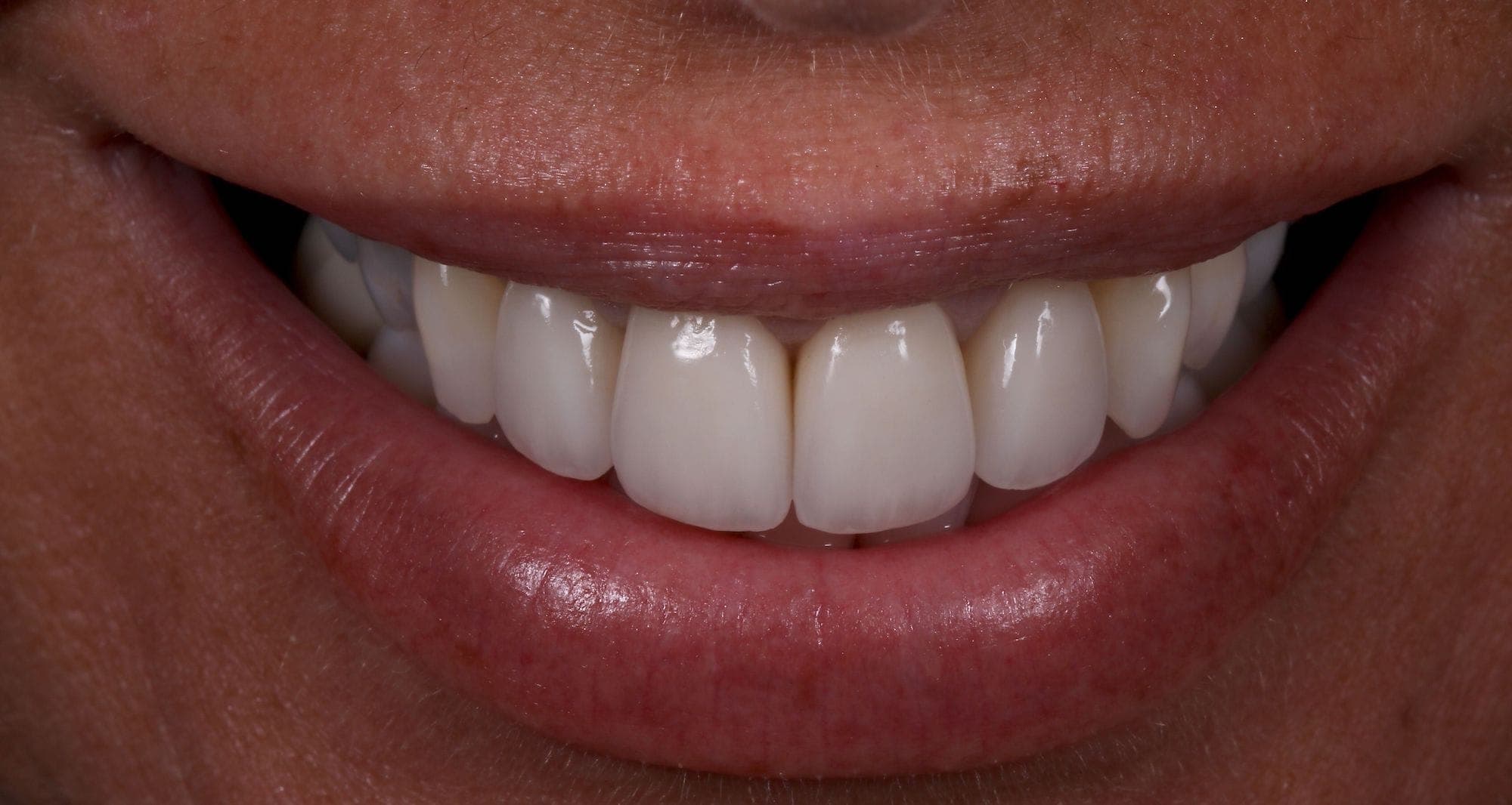 Vertical preparation of upper incisors The Restorative Programme